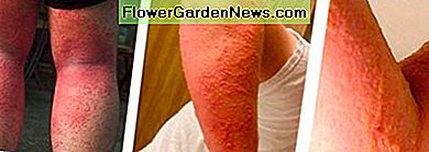 fotó: poison-ivy.org Allergiás reakció a méregvizekre a lábak hátulján lévő bőrrel való érintkezés után és az allergiás reakció - a méregtelenséggel való érintkezésből származó hólyagok